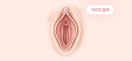 음핵수술방법 이미지