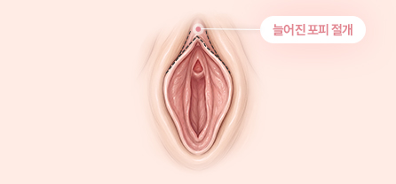 음핵수술방법 이미지