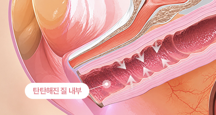 이브로 시술 전 이미지