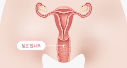 오르가니 시술 전 이미지