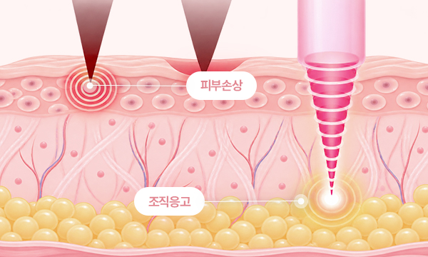 기존 레이저 장비 효과 일러스트