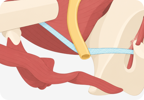 세라산부인과 미니슬링 수술 방법 이미지