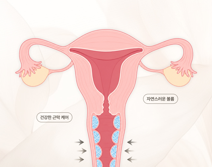 세라산부인과 시크릿필 설명 이미지