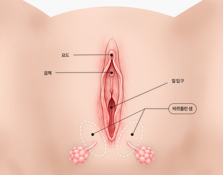 세라산부인과 바르톨린낭종 설명 이미지
