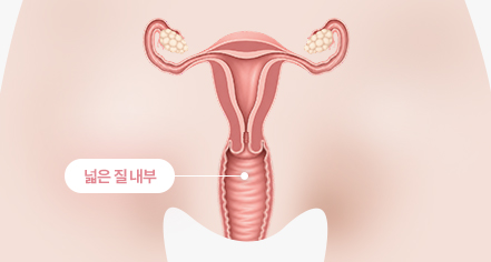 HA필 시술 전 이미지
